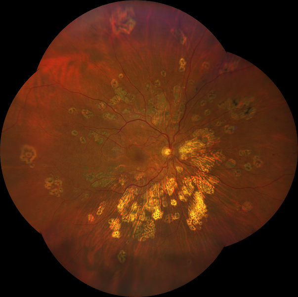 Imaging di retinopatia diabetica